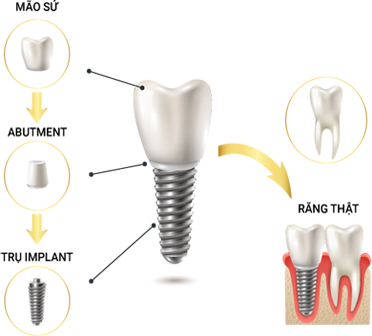 Cấy ghép implant1