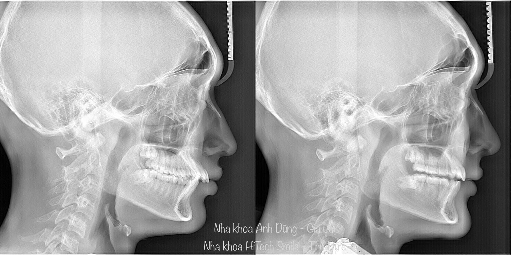 Chụp X-quang 3D - Nha khoa Anh Dũng Gia Lai