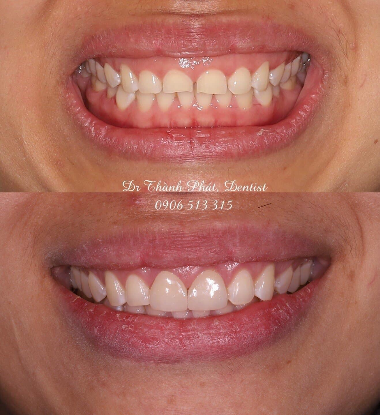 Dán răng sứ Veneer - Trắng sáng bền màu trong một nốt nhạc