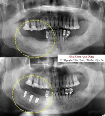 IMPLANT