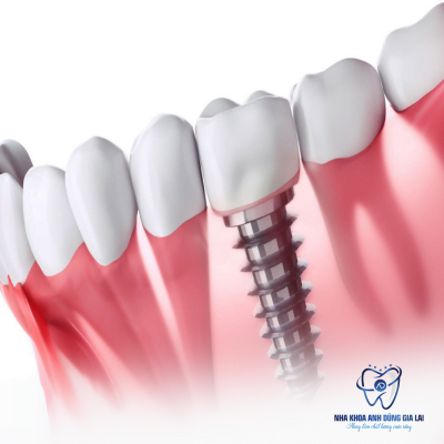 NHA KHOA UY TÍN PLEIKU - NHA KHOA ANH DŨNG