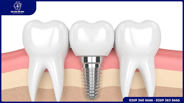Cấy ghép Implant là gì?