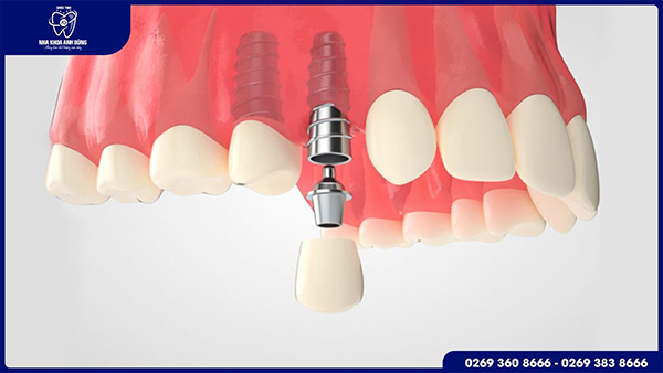 Cấy ghép implant