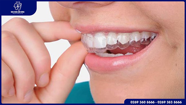 Niềng răng trong suốt Invisalign