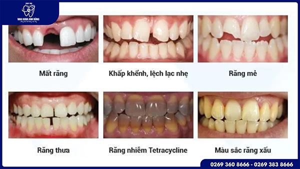 Trường hợp nào có thể bọc răng sứ?