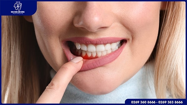 Bệnh nha chu là bệnh gì?