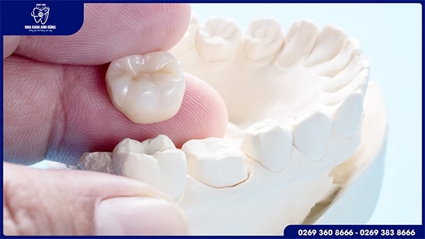 Vậy khi bị nha chu có bọc răng sứ được không? 