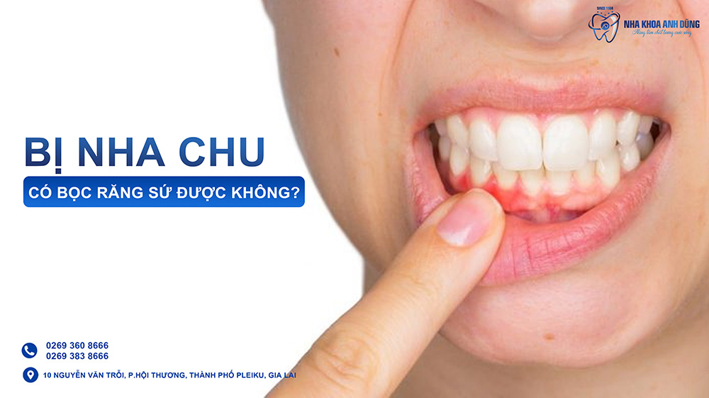 Bị nha chu có bọc răng sứ được không?