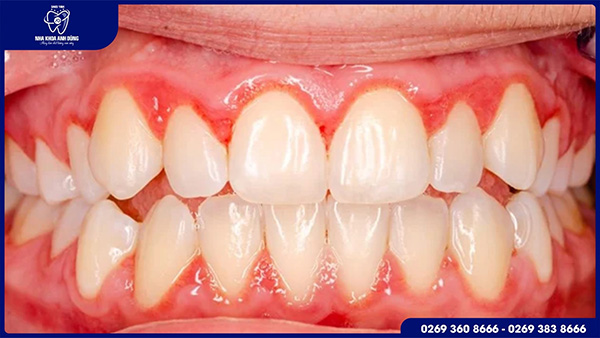 Dấu hiệu cho thấy bạn bị viêm lợi sau khi bọc răng sứ