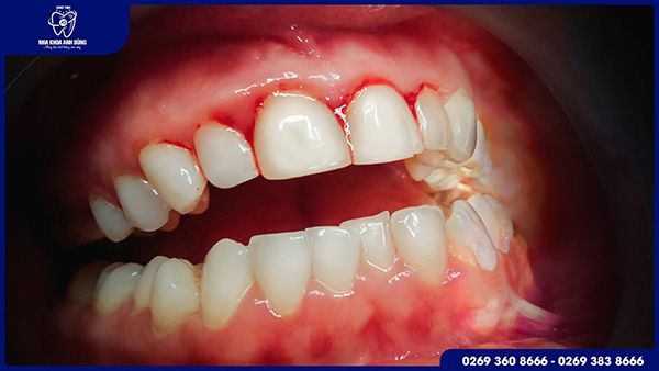 Những nguyên nhân làm cho bọc răng sứ bị viêm lợi