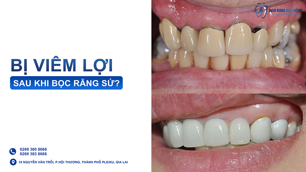 Bị viêm lợi sau khi bọc răng sứ, nguyên nhân do đâu?