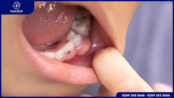 Viêm nướu, viêm lợi, hôi miệng
