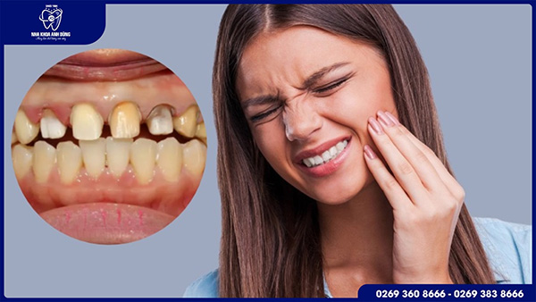 Lưu ý trước và sau khi bọc răng sứ để tránh biến chứng
