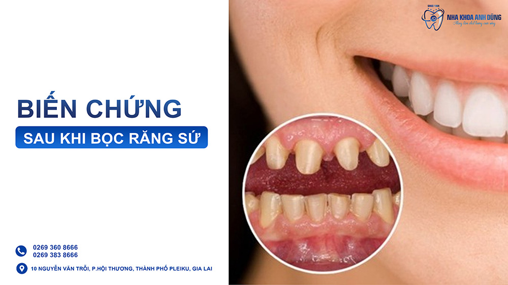 Cảnh báo 5 biến chứng sau khi bọc răng sứ kém chất lượng