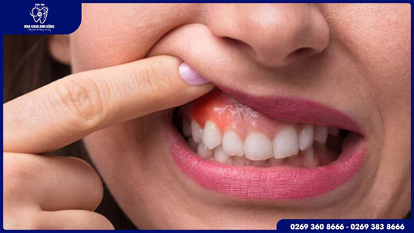 Lợi bị sưng hoặc đau nhức có mủ