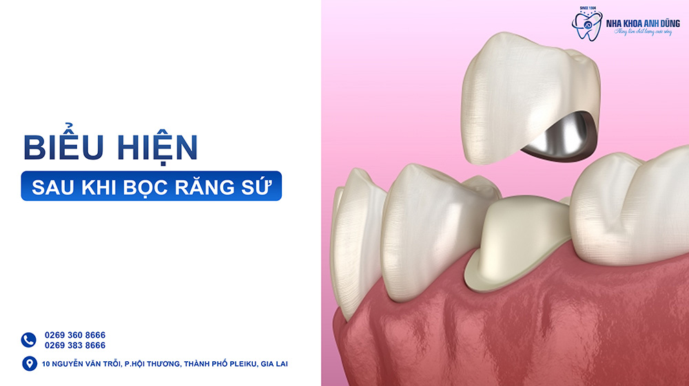 Những biểu hiện sau khi bọc răng sứ mà bạn nên biết