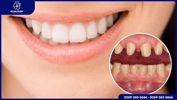 Bọc răng sứ thẩm mỹ là gì?