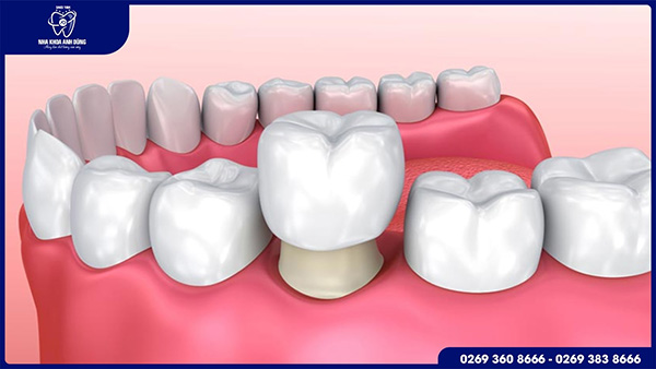 Bọc răng sứ 1 chiếc được không?