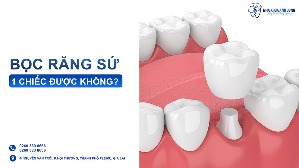Bọc răng sứ 1 chiếc được không? Giá bao nhiêu tiền?