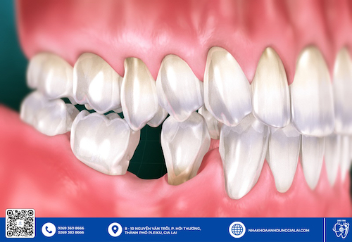Ảnh hưởng của việc mất răng