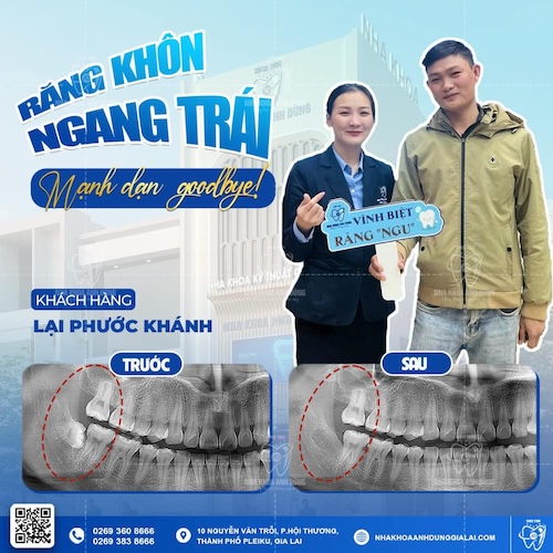 Khách hàng Lại Phước Khánh nhổ tiểu phẫu răng 48 mọc lệch 90 độ để tránh biến chứng