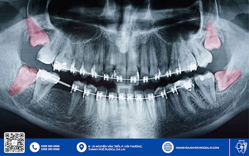 Một số người sẽ mọc đủ hết 4 răng khôn