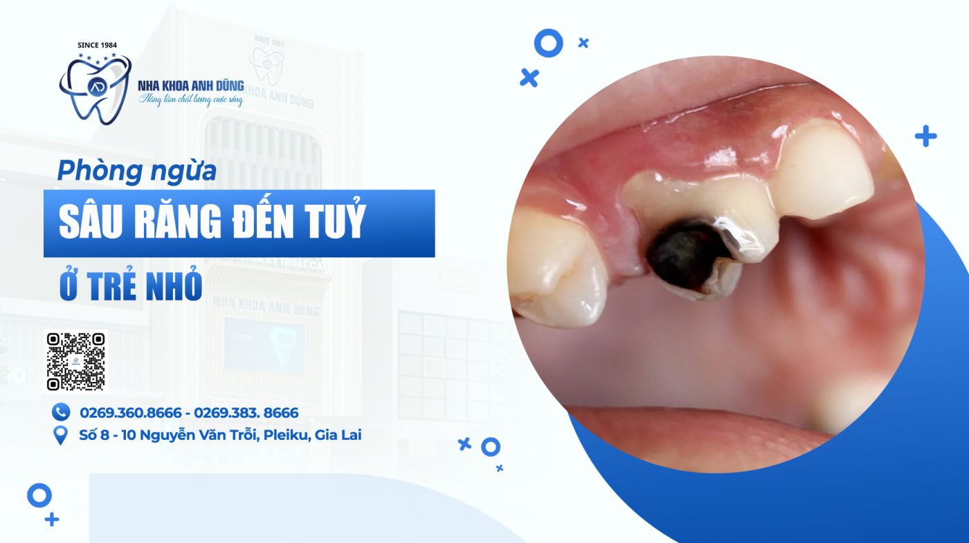 PHÒNG NGỪA SÂU RĂNG ĐẾN TỦY Ở TRẺ NHỎ