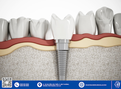 Trồng răng Implant khi bị mất răng giúp bạn đảm bảo chức năng ăn nhai và tính thẩm mỹ của răng