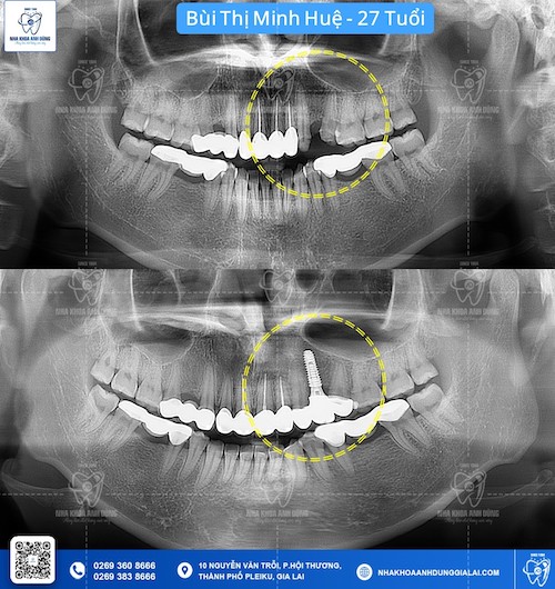 Trồng răng Implant tại Nha Khoa Anh Dũng với trụ Implant nhập khẩu chính hãng giúp khách hàng yên tâm hơn