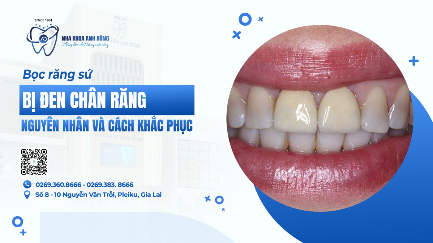 Bọc răng sứ bị đen chân răng, nguyên nhân và cách khắc phục