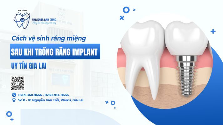 Cách vệ sinh răng miệng sau khi trồng răng Implant uy tín Gia Lai