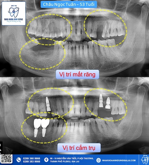 trụ implant straumann uy tín gia lai
