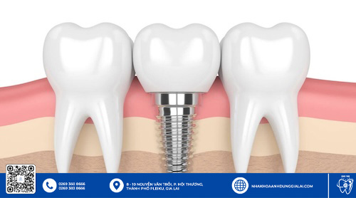 Trụ Implant Hiossen chất lượng Gia Lai an toàn và lành tính