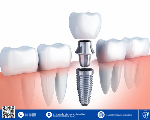 Trụ Implant Hiossen chất lượng Gia Lai được nhiều khách hàng tin dùng