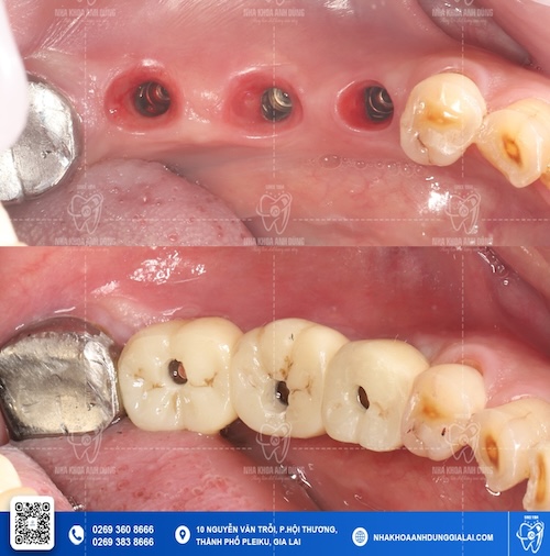 trụ implant straumann uy tín gia lai