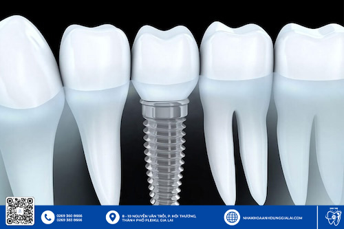 Tuổi thọ của trụ Hiossen được đánh giá cao hơn các dòng khác