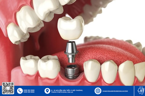 Chức năng ăn nhai sau khi trồng trụ Implant Magicore chất lượng Gia Lai được đảm bảo