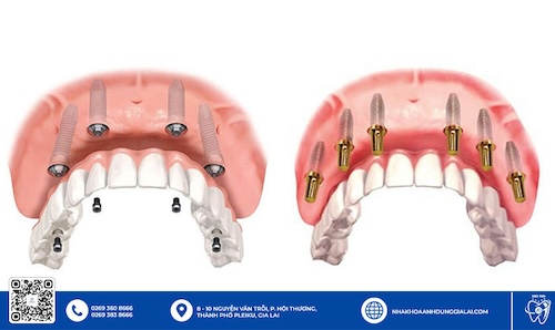 tụ implant nobel chất lượng gia lai