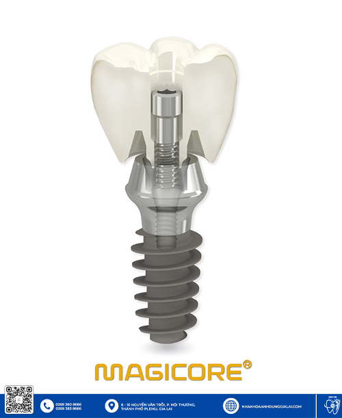 Những ưu điểm nổi bật của trụ Implant Magicore chất lượng Gia Lai
