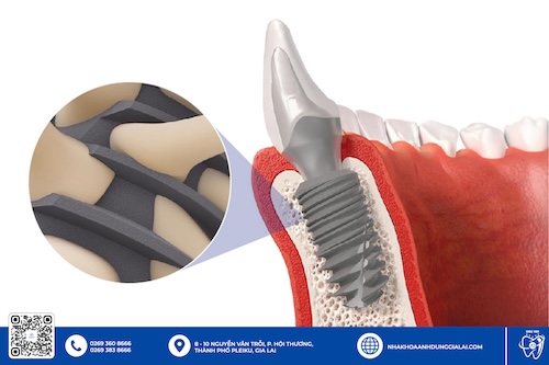 trụ implant tekka uy tín pleiku