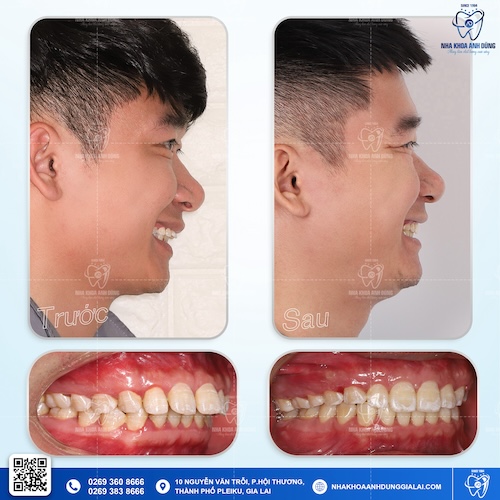 tình trạng răng vẩu