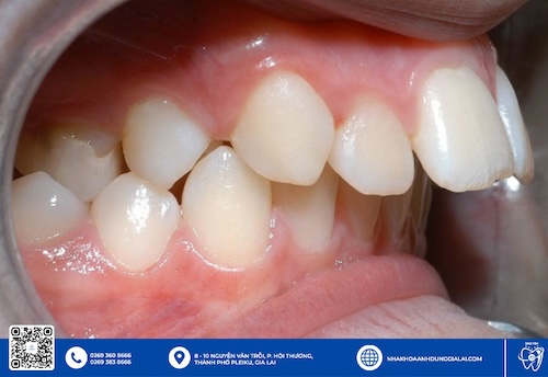 tình trạng răng vẩu
