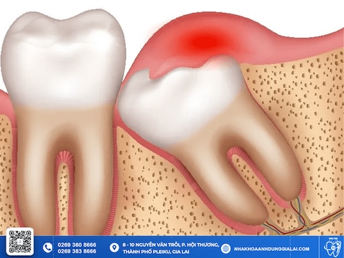viêm lợi trùm răng khôn