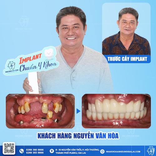 rụng răng sớm