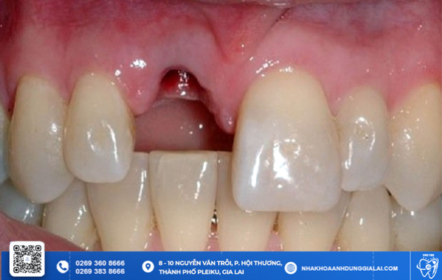 Ppepe Rung Rang NGUYÊN NHÂN, HẬU QUẢ CỦA RỤNG RĂNG SỚM VÀ CÁCH KHẮC PHỤC