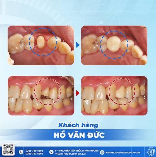 răng bọc sứ bị đau