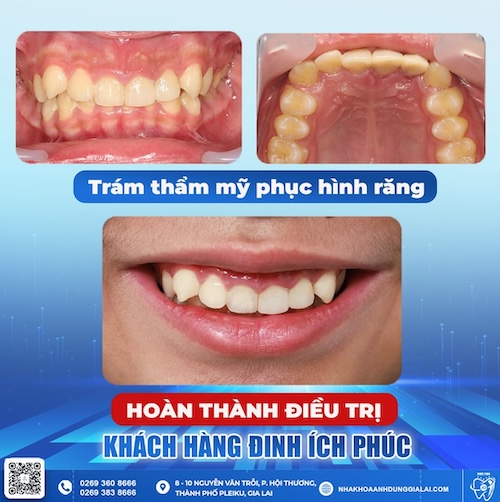 trám răng sai quy trình