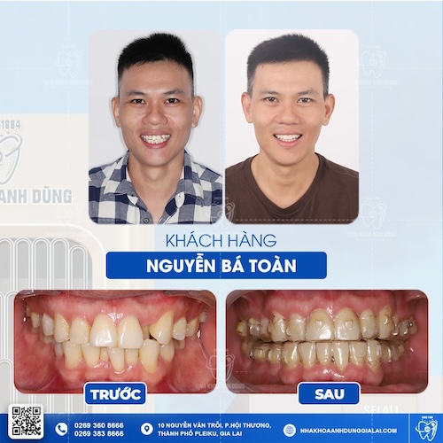 niềng răng tháo lắp