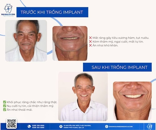 người lớn tuổi bị mất răng