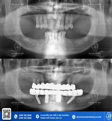 implant-all-on-4